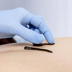 Гирудотерапия в санатории "Колос"